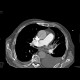 bronchial carcinoma, central, pneumonitis: CT - Computed tomography